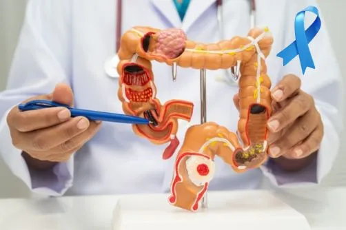 El cáncer colorrectal es el tipo de cáncer que más muertes está causando en personas menores de 50 años